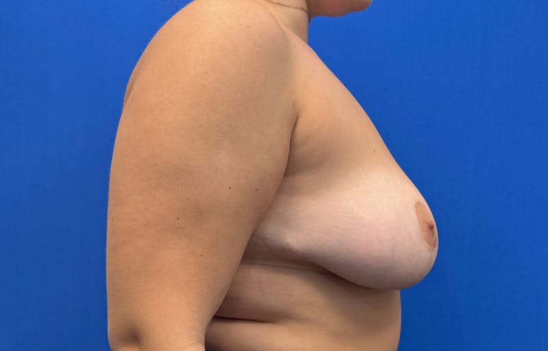 Breast Reduction Before & After Gallery - Patient 294917 - Image 10