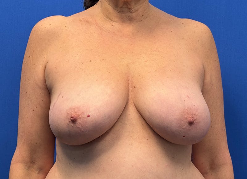 Breast Lift Before & After Gallery - Patient 249406 - Image 5
