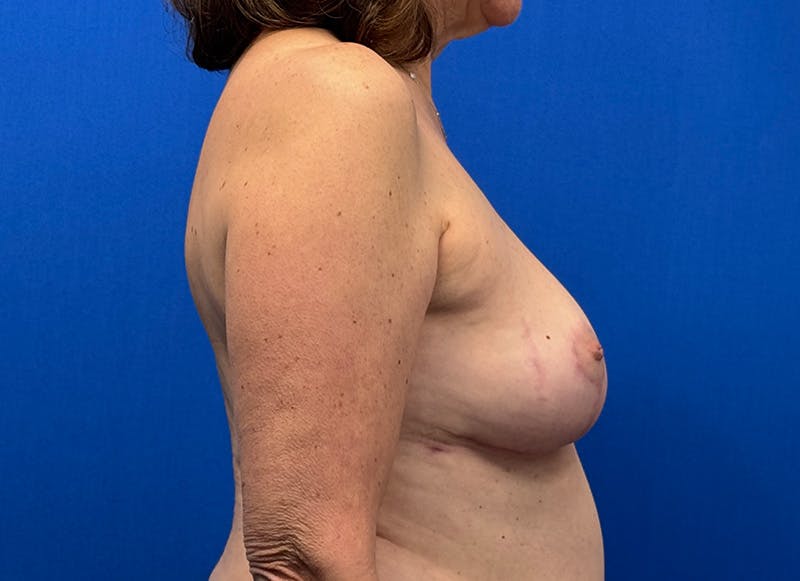 Breast Lift Before & After Gallery - Patient 249406 - Image 10
