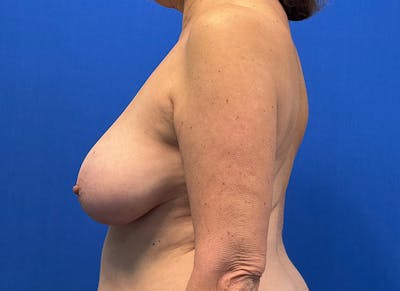 Breast Lift Before & After Gallery - Patient 249406 - Image 1