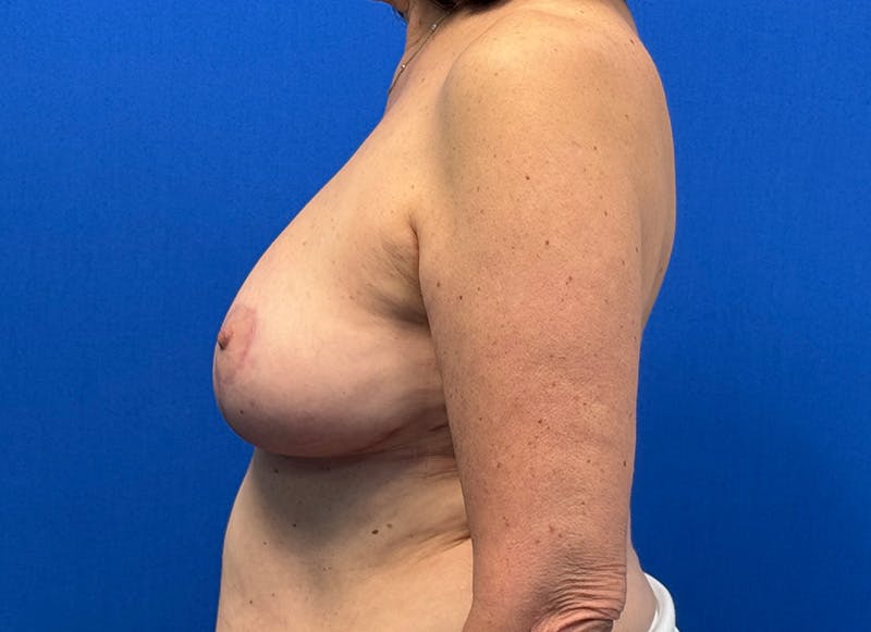 Breast Lift Before & After Gallery - Patient 249406 - Image 2