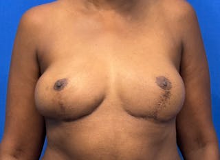 Flap Reconstruction Gallery Before & After Gallery - Patient 845593 - Image 6