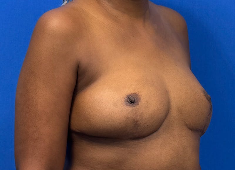 Flap Reconstruction Gallery Before & After Gallery - Patient 845593 - Image 8