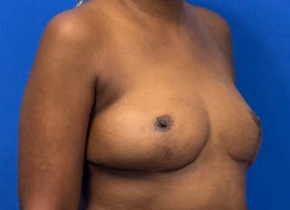 Flap Reconstruction Gallery Before & After Gallery - Patient 845593 - Image 8