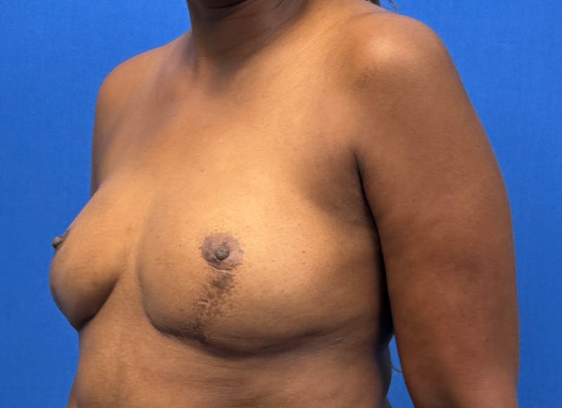 Flap Reconstruction Gallery Before & After Gallery - Patient 845593 - Image 4