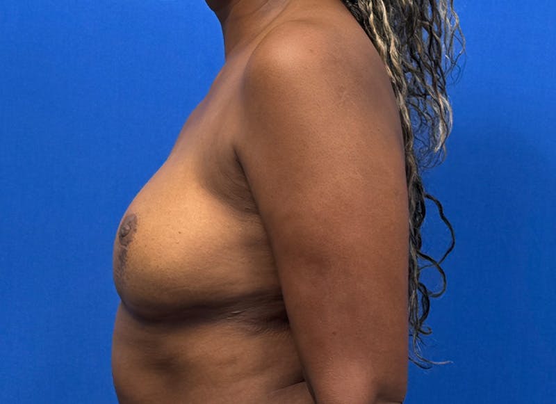 Flap Reconstruction Gallery Before & After Gallery - Patient 845593 - Image 2
