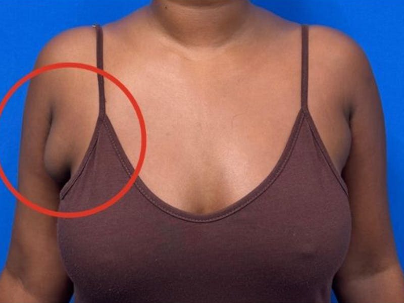 Axillary Breast Removal Before & After Gallery - Patient 134100 - Image 5