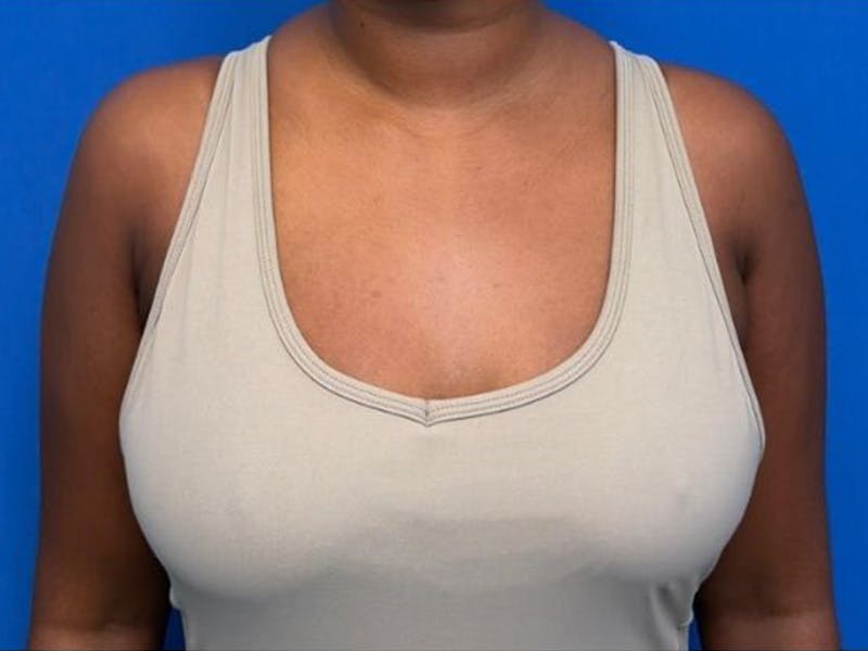 Axillary Breast Removal Before & After Gallery - Patient 134100 - Image 6