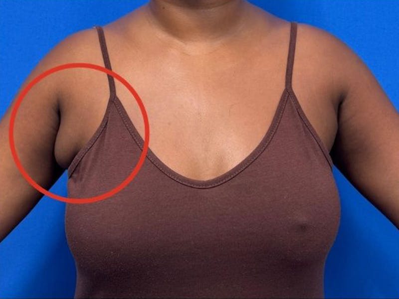 Axillary Breast Removal Before & After Gallery - Patient 134100 - Image 3