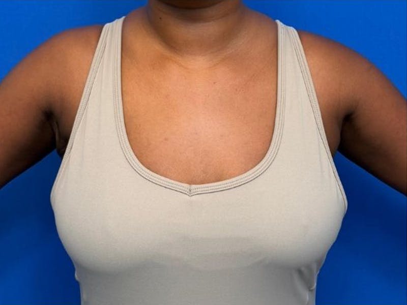 Axillary Breast Removal Before & After Gallery - Patient 134100 - Image 4