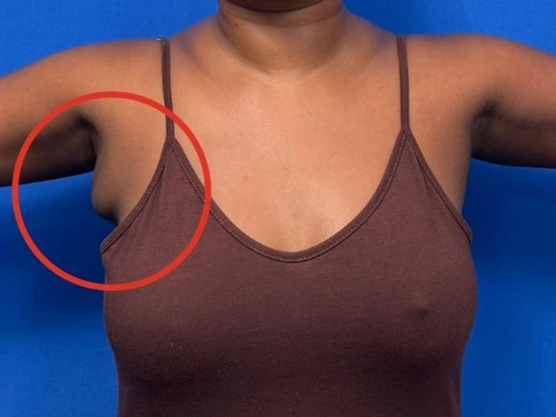 Axillary Breast Removal Before & After Gallery - Patient 134100 - Image 1