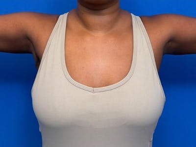 Axillary Breast Removal Before & After Gallery - Patient 134100 - Image 2