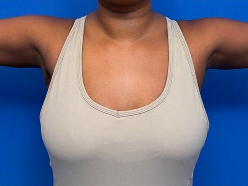 Axillary Breast Removal Before & After Gallery - Patient 134100 - Image 2
