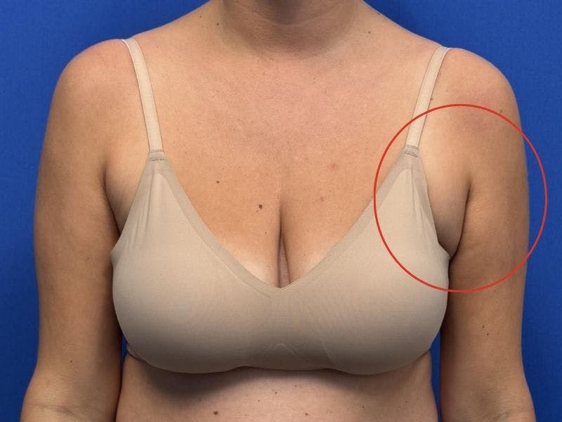 Axillary Breast Removal Before & After Gallery - Patient 331089 - Image 5