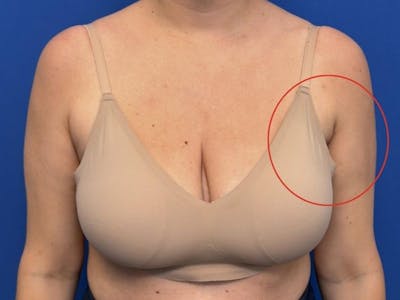 Axillary Breast Removal Before & After Gallery - Patient 331089 - Image 2