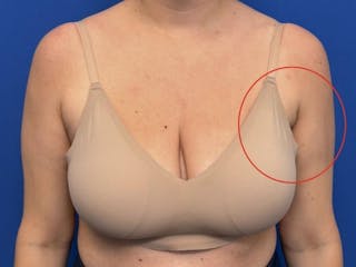 Axillary Breast Removal Before & After Gallery - Patient 331089 - Image 2