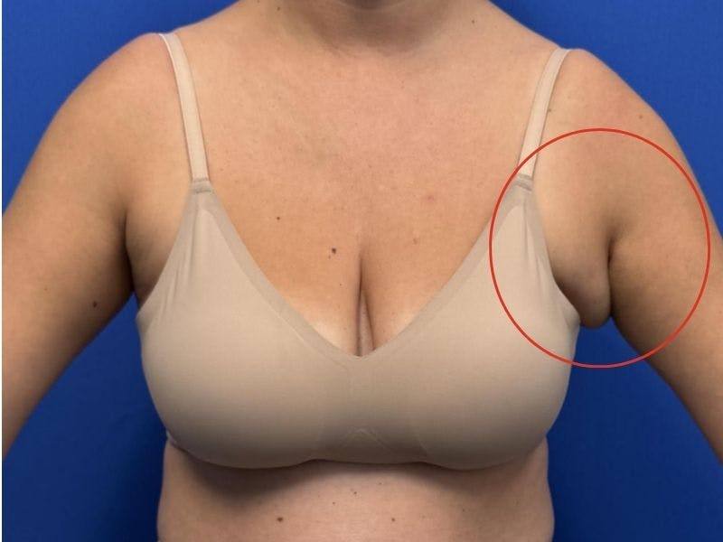 Axillary Breast Removal Before & After Gallery - Patient 331089 - Image 1