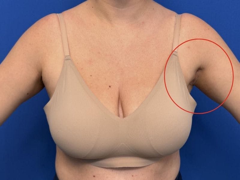 Axillary Breast Removal Before & After Gallery - Patient 331089 - Image 6