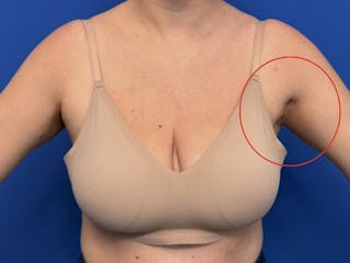 Axillary Breast Removal Before & After Gallery - Patient 331089 - Image 6