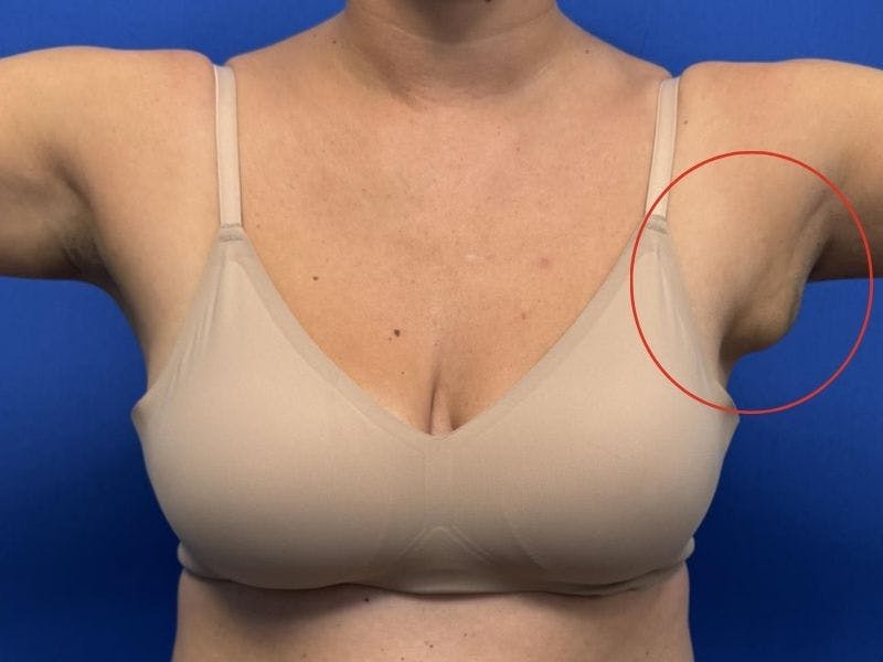 Axillary Breast Removal Before & After Gallery - Patient 331089 - Image 3