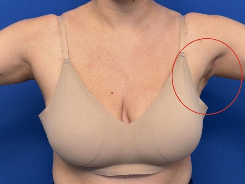 Axillary Breast Removal Before & After Gallery - Patient 331089 - Image 4