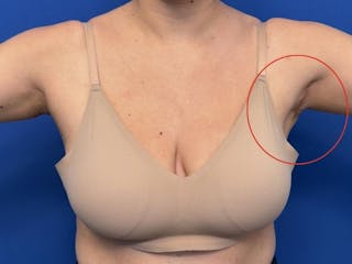 Axillary Breast Removal Before & After Gallery - Patient 331089 - Image 4