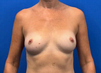 Flap Reconstruction Gallery Before & After Gallery - Patient 400578 - Image 5