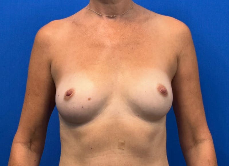 Flap Reconstruction Gallery Before & After Gallery - Patient 400578 - Image 5