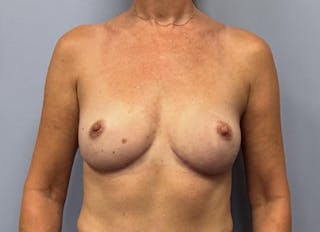 Flap Reconstruction Gallery Before & After Gallery - Patient 400578 - Image 6