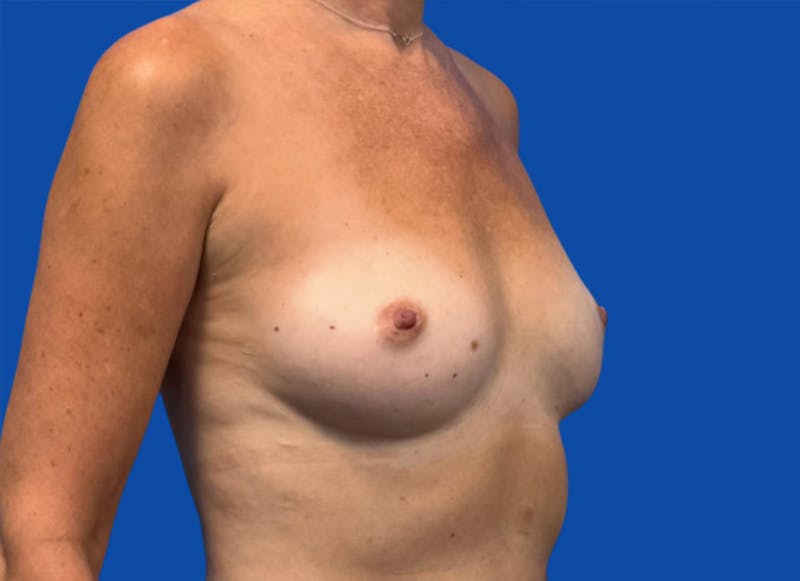 Flap Reconstruction Gallery Before & After Gallery - Patient 400578 - Image 7