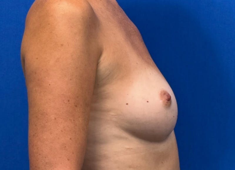 Flap Reconstruction Gallery Before & After Gallery - Patient 400578 - Image 9