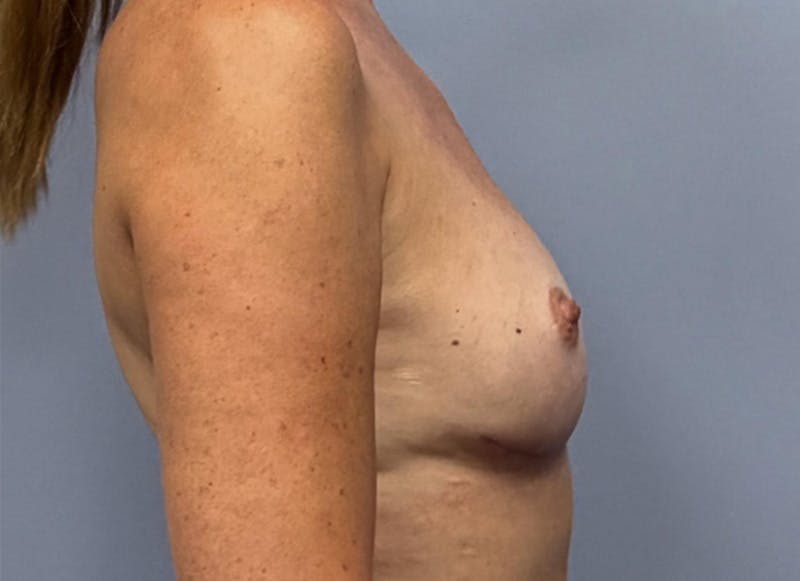 Flap Reconstruction Gallery Before & After Gallery - Patient 400578 - Image 10
