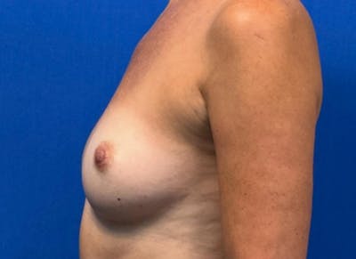 Flap Reconstruction Gallery Before & After Gallery - Patient 400578 - Image 1