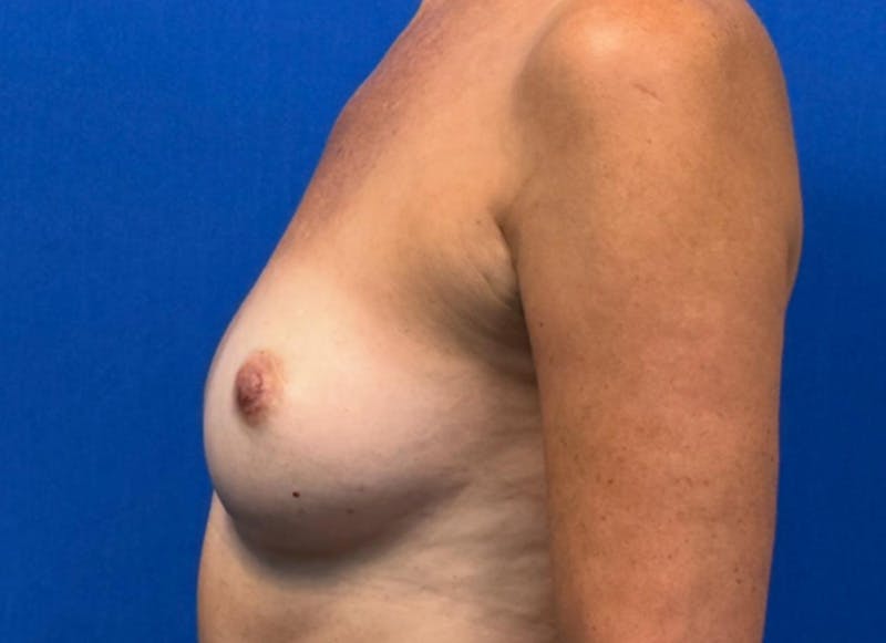 Flap Reconstruction Gallery Before & After Gallery - Patient 400578 - Image 1