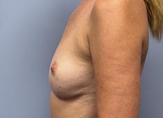 Flap Reconstruction Gallery Before & After Gallery - Patient 400578 - Image 2