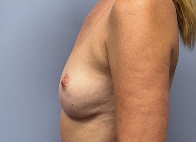 Flap Reconstruction Gallery Before & After Gallery - Patient 400578 - Image 2