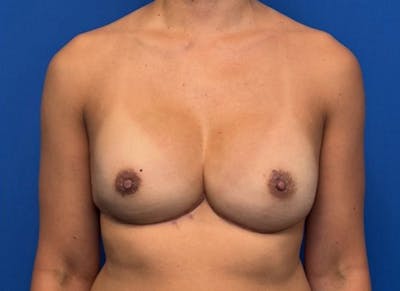 Implant Reconstruction Gallery Before & After Gallery - Patient 150462 - Image 6