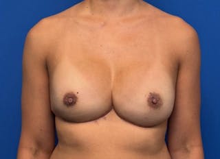 Implant Reconstruction Gallery Before & After Gallery - Patient 150462 - Image 6