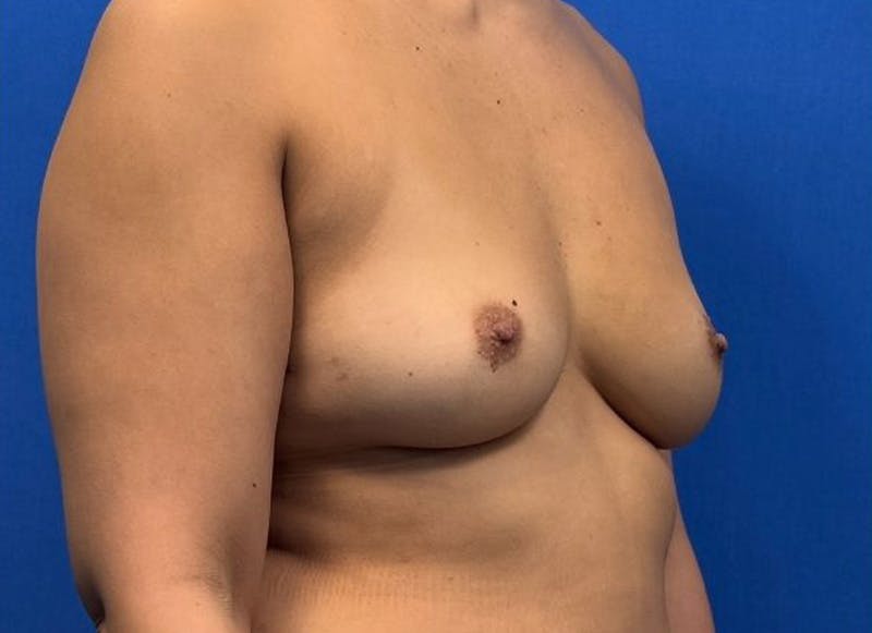 Implant Reconstruction Gallery Before & After Gallery - Patient 150462 - Image 7