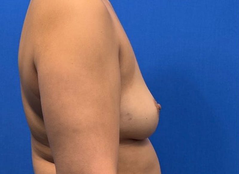Implant Reconstruction Gallery Before & After Gallery - Patient 150462 - Image 9