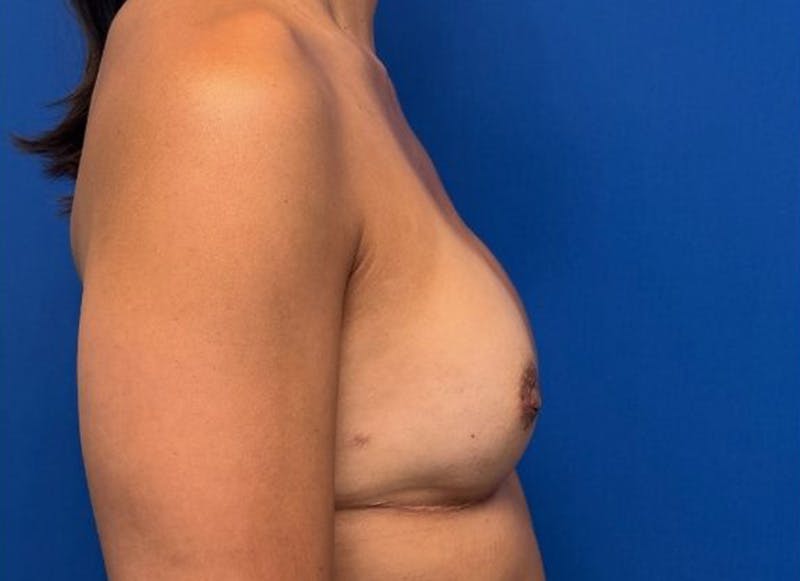 Implant Reconstruction Gallery Before & After Gallery - Patient 150462 - Image 10