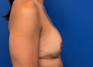 Implant Reconstruction Gallery Before & After Gallery - Patient 150462 - Image 10