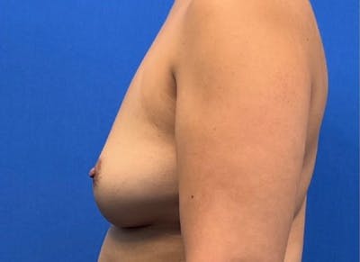 Implant Reconstruction Gallery Before & After Gallery - Patient 150462 - Image 1