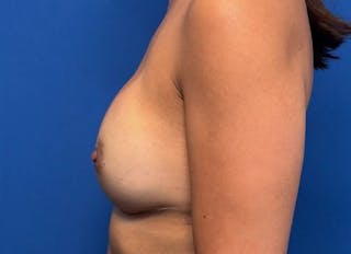 Implant Reconstruction Gallery Before & After Gallery - Patient 150462 - Image 2