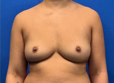 Implant Reconstruction Gallery Before & After Gallery - Patient 150462 - Image 5
