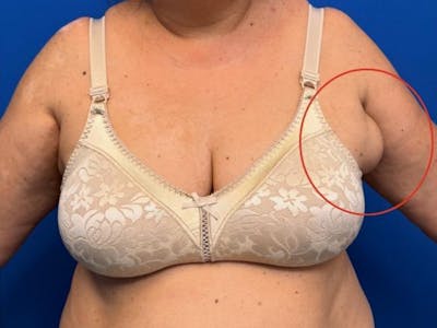 Axillary Breast Removal Before & After Gallery - Patient 313960 - Image 1
