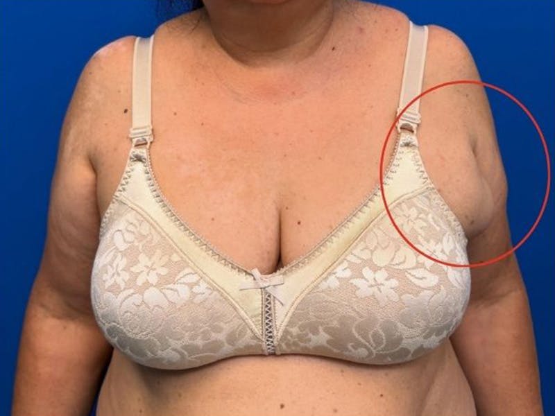 Axillary Breast Removal Before & After Gallery - Patient 313960 - Image 3