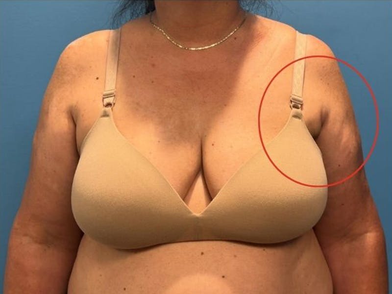 Axillary Breast Removal Before & After Gallery - Patient 313960 - Image 4