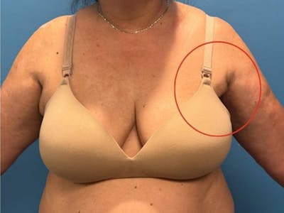 Axillary Breast Removal Before & After Gallery - Patient 313960 - Image 2