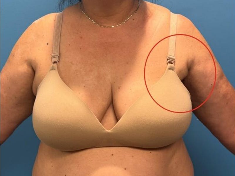Axillary Breast Removal Before & After Gallery - Patient 313960 - Image 2
